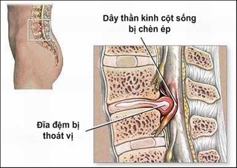 Thoát vị đĩa đệm thắt lưng - Hình ảnh minh họa